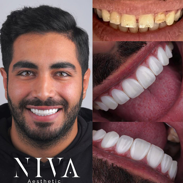 Slider image (6) Best Dental Clinic in Istanbul - Niva Aesthetic